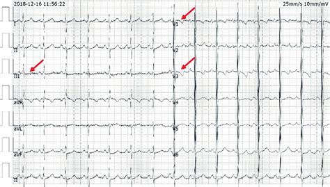 The ECG showed T-wave morphology changes in several leads (III, V1, V3 ...