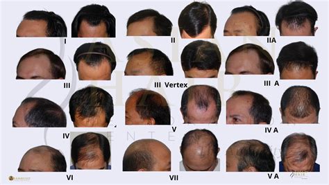 Androgenic Alopecia Treatment | Updated Options | Dr. Julieta . Arambulo