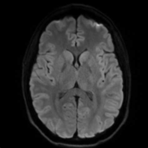 Normal Brain Mri