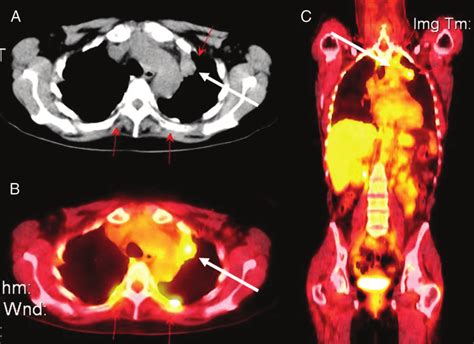 How Does Cancer Appear On A Pet Scan - PetsWall