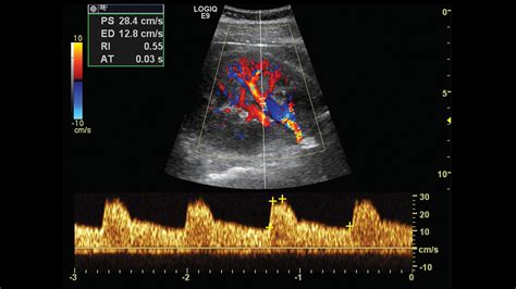 Segmental Renal Artery Ultrasound