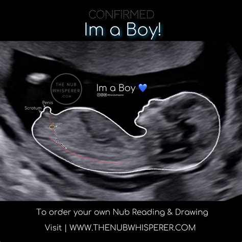 baby boy at 14 weeks ultrasound - Marylyn Luciano