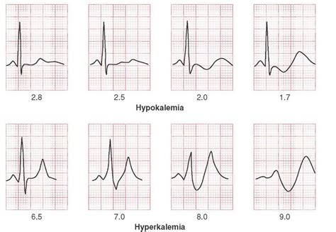 ECG changes associated with hypokalemia and hyperkalemia. Medical ...