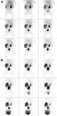 Nuclear Medicine Renal Imaging - Renal Fellow Network