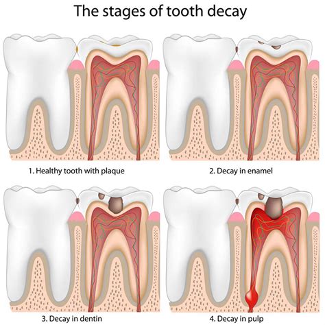 Tooth decay | healthdirect