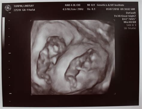 Adventures in Baby Making: 12 weeks ultrasound