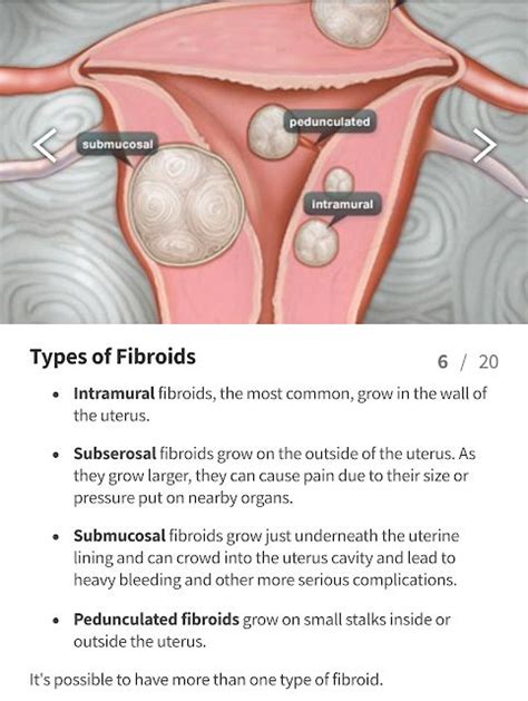 Uterine Fibroids | Fibroids, Uterine fibroids, Fibroids shrink