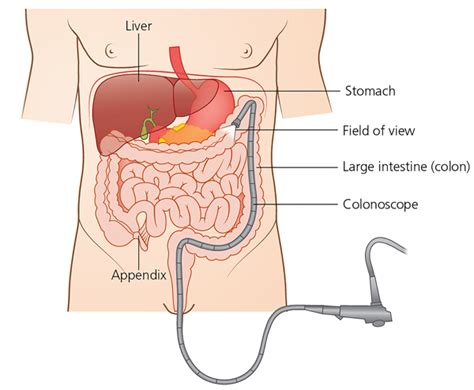 Obedient look in island colon colonoscopy Match in case Classic