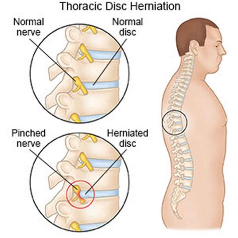 Thoracic Disc Bulge Treatment - Captions Beautiful