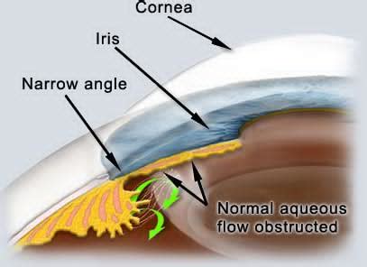 Glaucoma (Narrow Angle) - Pittsburgh, PA & Pittsburgh, PA - North Hills Eye Associates / Karlik ...