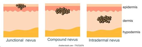 Junctional Melanocytic Nevus