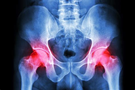 Hip Bursitis | Symptoms and Treatment Plans | OrthoIndy Blog