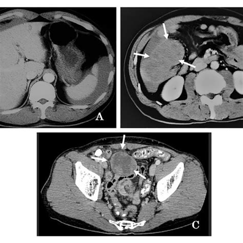 Computed tomography (CT) scan revealed hemoperitoneum (A, arrowheads)... | Download Scientific ...