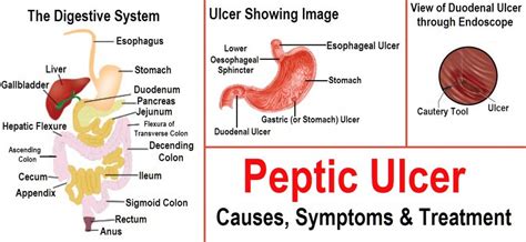 Some strategies how to manage Ulcer