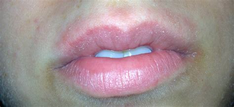 allergic reaction on lip - pictures, photos