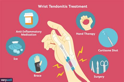 Extensor Tendonitis Tendinopathy Symptoms Causes And Treatment | Hot ...