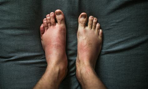 PODIATRIST DISCUSSES EFFECTS OF PSORIATIC ARTHRITIS ON FEET