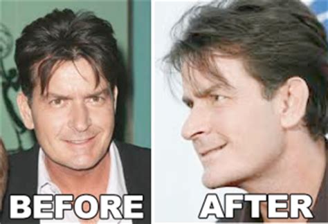 Charlie Sheen Nose Job Before After Photos