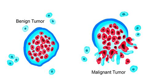 Tumor - StoryMD