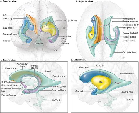 Ventricular and Periventricular Arteriovenous Malformations | Neupsy Key