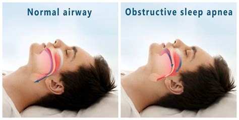 Sleep Apnea Machines | The Benefits of Using the Luna CPAP - Accessibility Medical Equipment