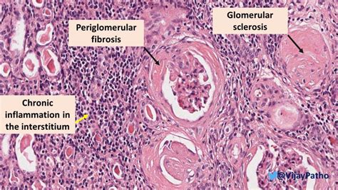 Chronic Pyelonephritis Histology