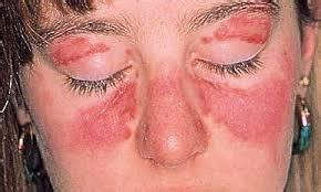 How Long Does Sun Poisoning Last – How Long Does Rash, Swelling & Sun Poisoning Pain Take to Go Away