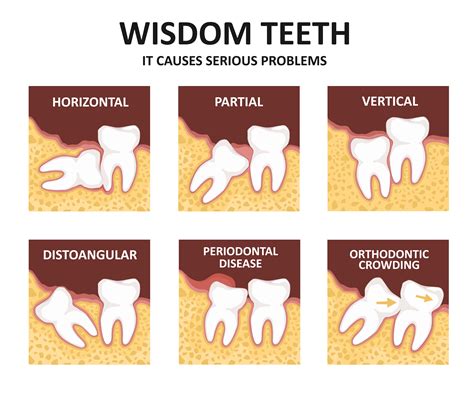 Wisdom Teeth Removal | Treatment | Wisdom Teeth Extraction