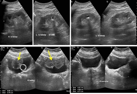 Synchronous urinary bladder and prostate cancer – Radiology Cases