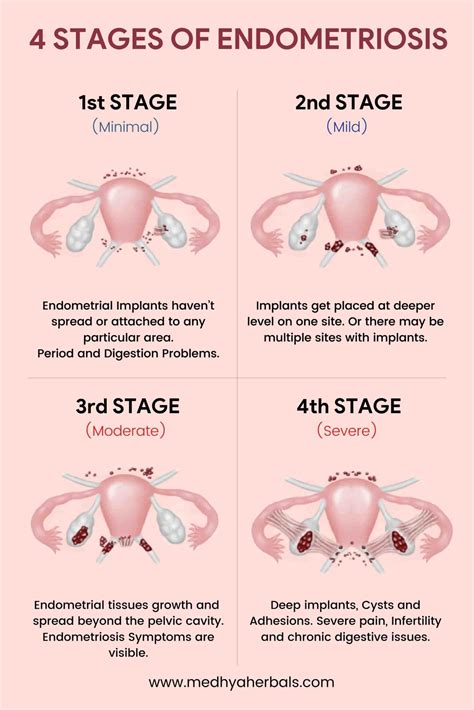 Endometriosis Symptoms: 5 Early Signs You Shouldn't Ignore