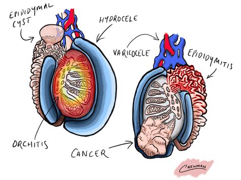 Testicular Cancer Pictures Of Lumps at Veronica Bartley blog