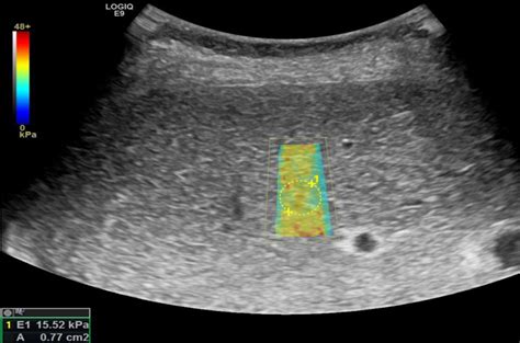 Noninvasive assessment of liver fibrosis in a real-world coh... : European Journal of ...