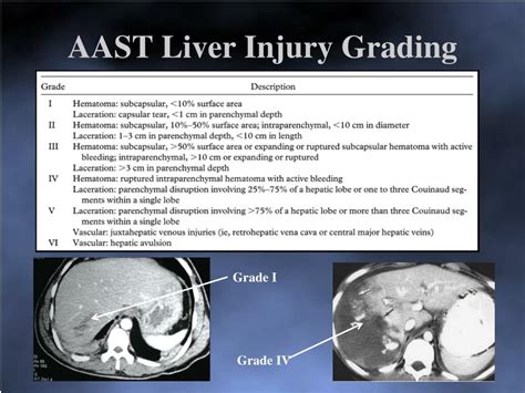 PPT - Management of Spleen/Liver Trauma PowerPoint Presentation, free download - ID:5231296