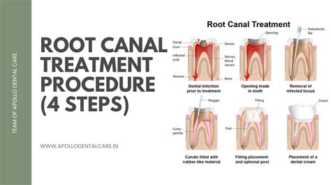 Root Canal Treatment Procedures (4 steps) - Apollo Dental Care