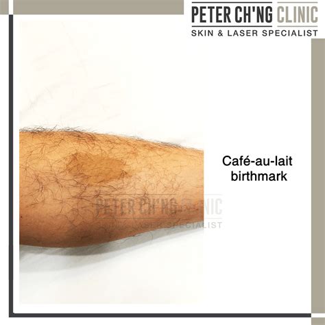 Patient Mailbox: How to Remove a Birthmark on the Face | Peter Ch'ng Skin Specialist - KL, Malaysia