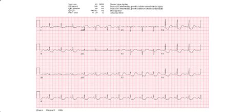 A 12-lead electrocardiogram demonstrating features of hypokalemia ...