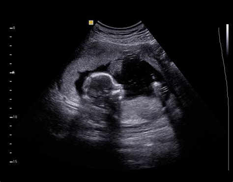 Ultrasound Baby Images - Baby Viewer