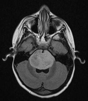 Benign tumor in brain | General center | SteadyHealth.com