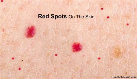 What causes red spots on the skin | How to get rid of the red spots on skin