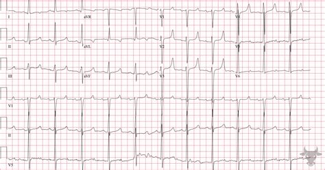 Hypocalcemia | ECG Stampede