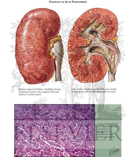 Acute Pyelonephritis: Pathology