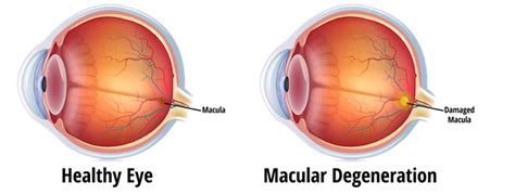 Macular Degeneration · Family Eye Care of O'Fallon