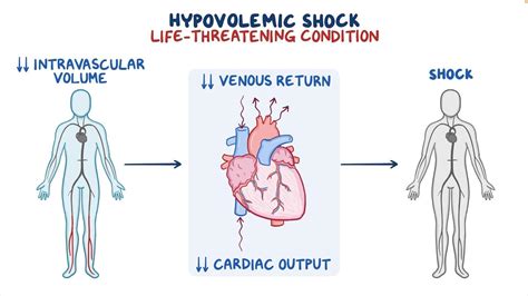 Hypovolemic shock: Video & Meaning | Osmosis