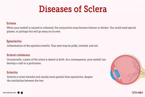 Sclera (Human Anatomy): Image, Functions, Diseases and Treatments