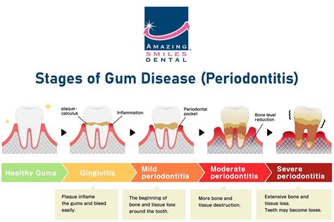 Periodontitis - Gum Disease: Symptoms, Causes, & Treatment