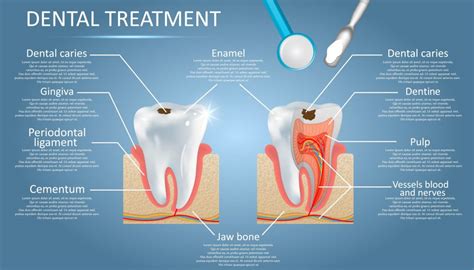 Tooth Cavity Filling