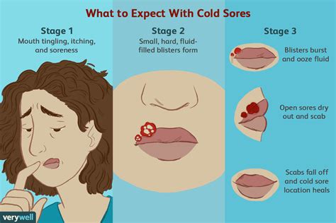 Cold Sore Outbreaks: Causes, Symptoms, Stages, Treatments