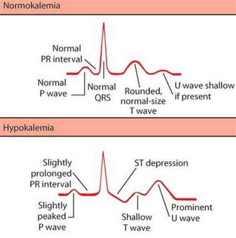 Hypokalemia - Symptoms, Causes, ECG and Treatment