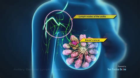 Axillary Sentinel Lymph Node Biopsy Video | Medical Video Library