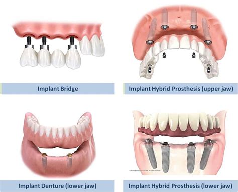 Types of Dental Implant Restorations | Dr. Coker & Dr. Ho